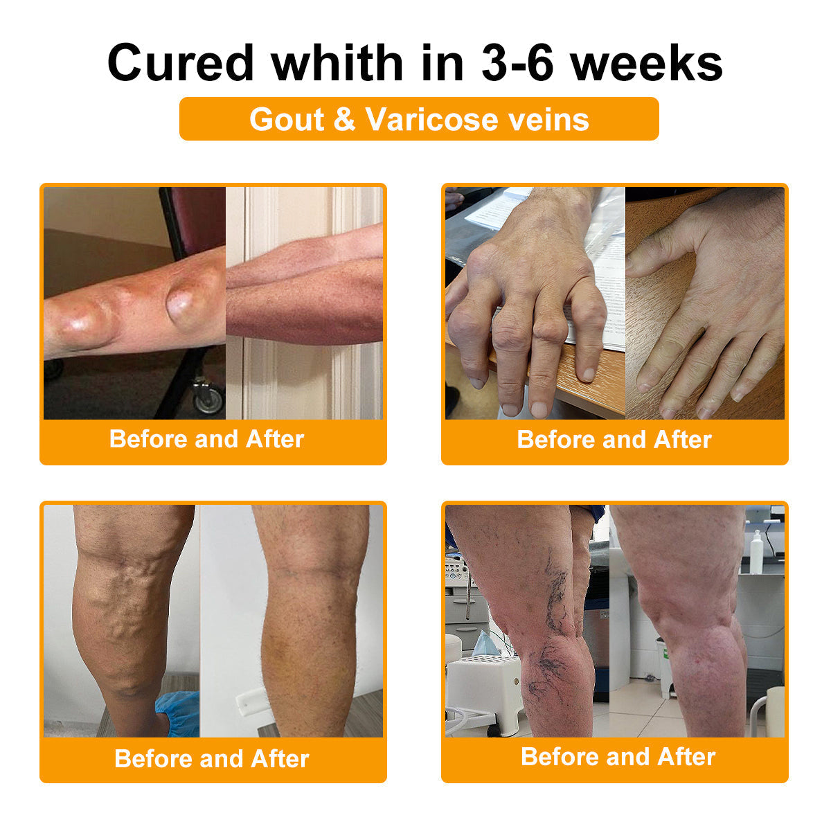 Pureluxo® Botulinum Toxin és Méhméreg Fájdalomcsillapító Csontgyógyító Krém🐝🌿 (Kifejezetten időseknek & ortopéd szakorvosok ajánlásával)🔥🔥🔥🔥🔥