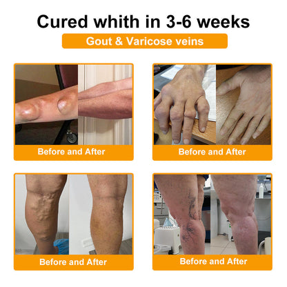 Pureluxo® Botulinum Toxin és Méhméreg Fájdalomcsillapító Csontgyógyító Krém🐝🌿 (Kifejezetten időseknek & ortopéd szakorvosok ajánlásával)🔥🔥🔥🔥🔥