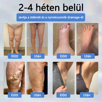 Cvreoz® Fekete kömény Ödéma méregtelenítő gyógynövénykrém - a gyors, látható enyhülés érdekében🍃🍃