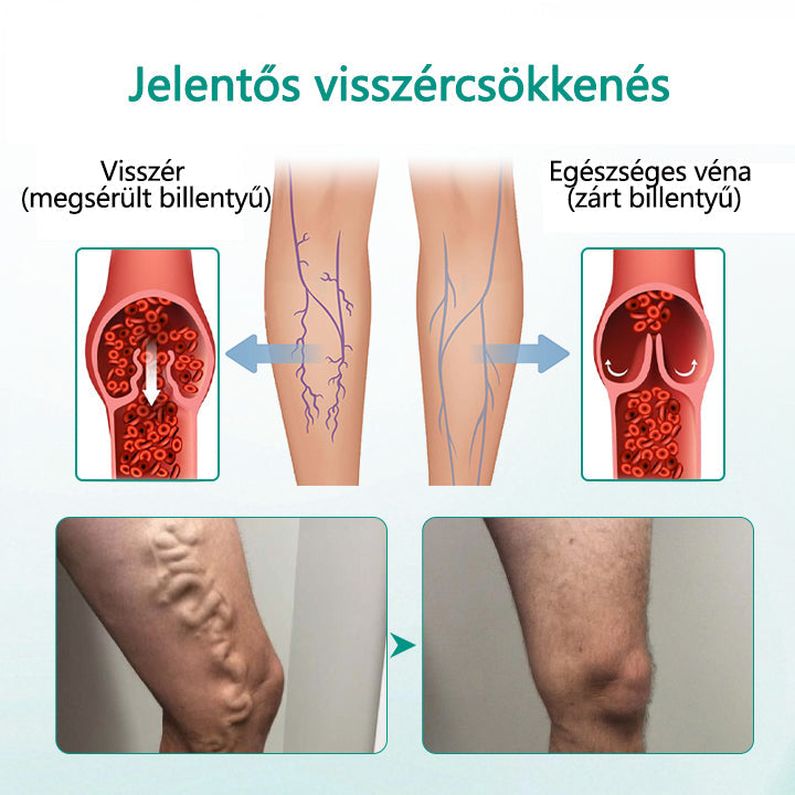 Cvreoz® LegRenew visszér tapasz javítja a vénák egészségét és megszünteti a visszereket🌿Nincs tű, nincs műtét, csak biztonságos, gyengéd és hatékony eredmény✨✨